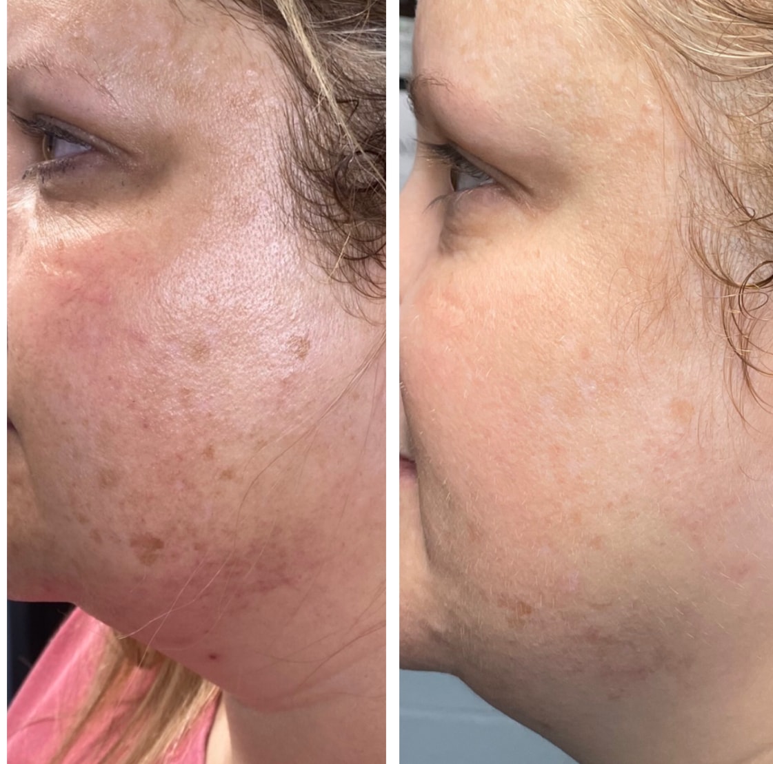 Before and after skin transformation showing clearer, smoother complexion after 5 months of Rhonda Allison skincare