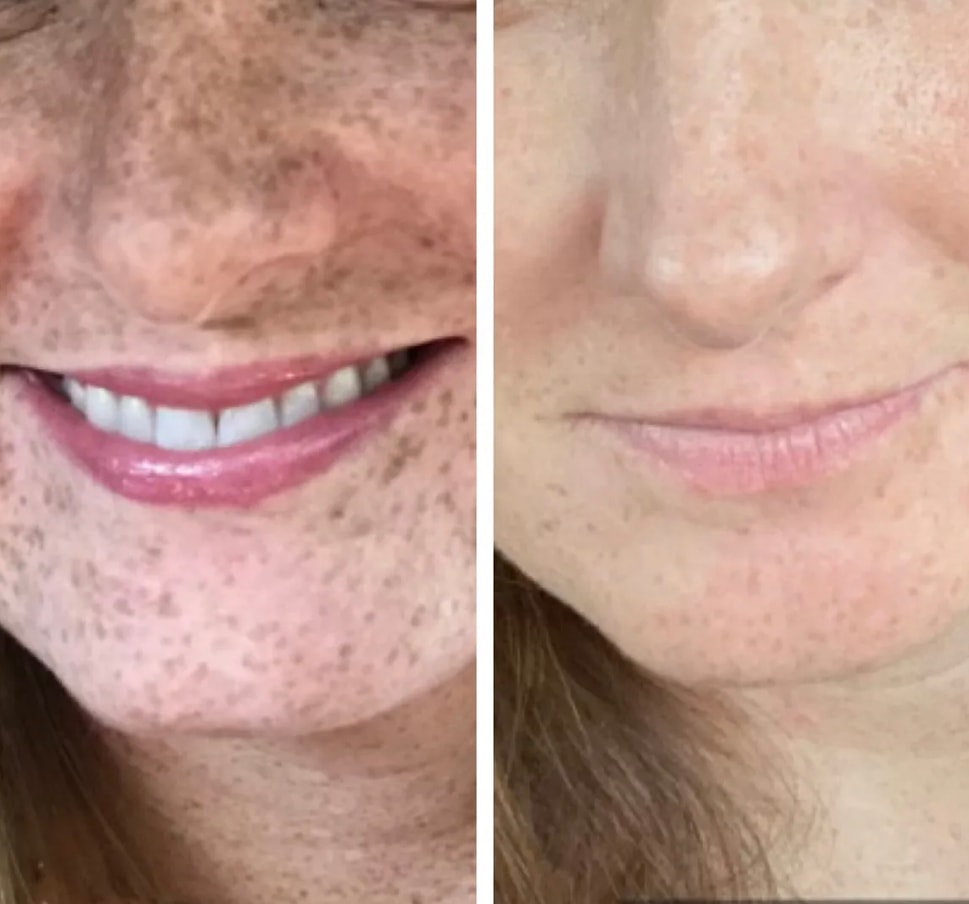 Before and after skin transformation showing reduced hyperpigmentation after 3 corrective facials and 3 months of products