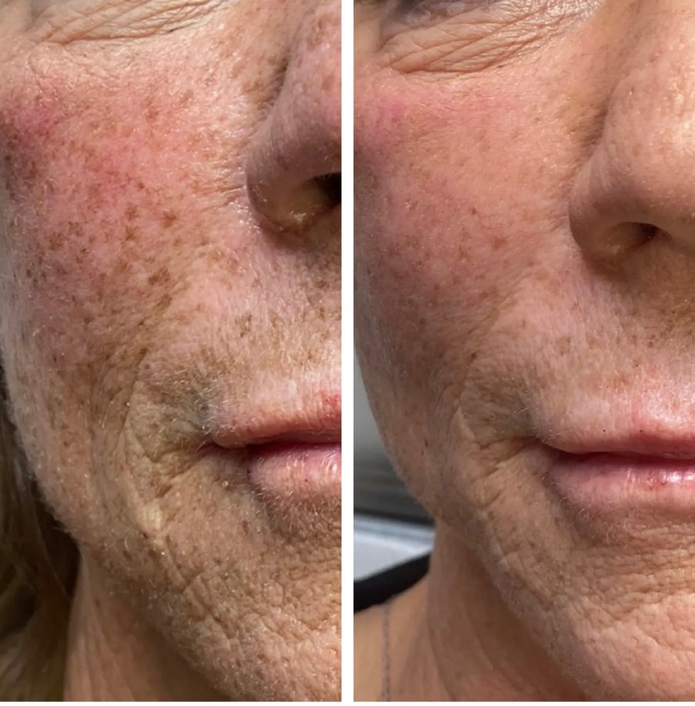 Before and after skin transformation showing improved texture and reduced redness after home microneedling kit and 1 Hydra Glow facial