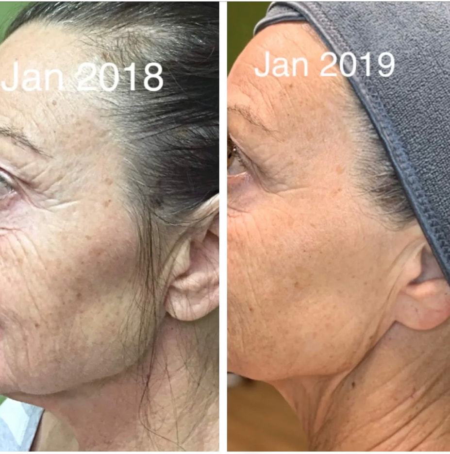 Before and after skin transformation Jan 2018 to Jan 2019 showing reduced fine lines and improved skin tone with Rhonda Allison skincare regimen and monthly facials
