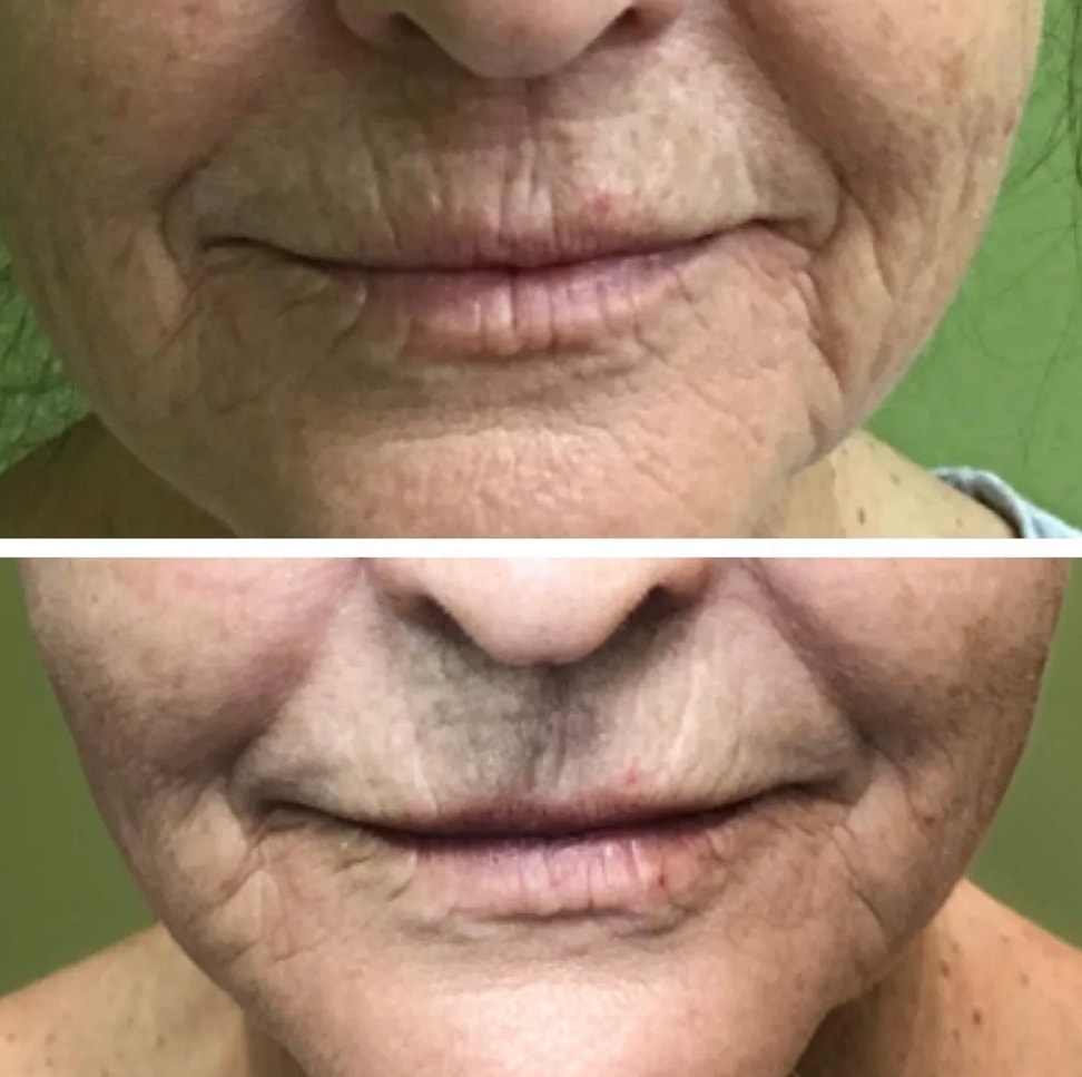 Before and after skin transformation showing reduced perioral lines and improved skin texture with Rhonda Allison skincare regimen and monthly facials